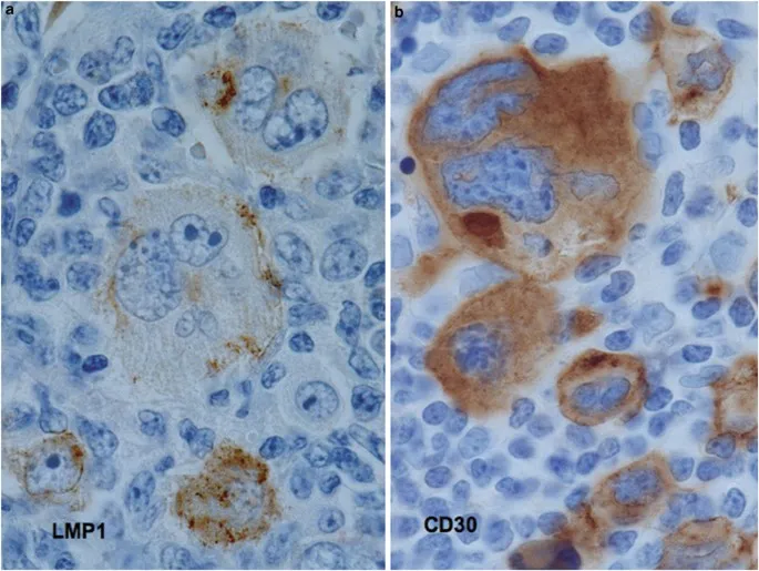 Reed-Sternberg cells with LMP1 and CD30 staining