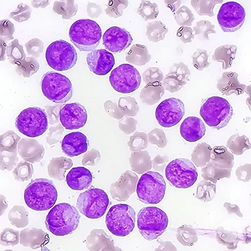 Peripheral blood smear showing blasts