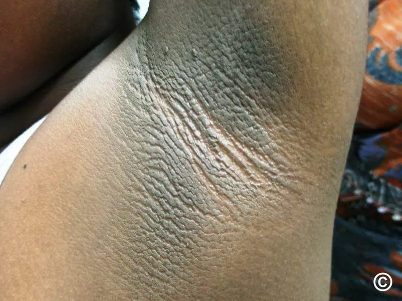 Acanthosis nigricans in axilla