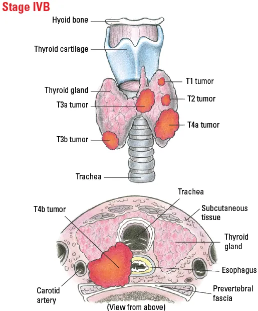 Thyroid Cancer T-Staging Diagram