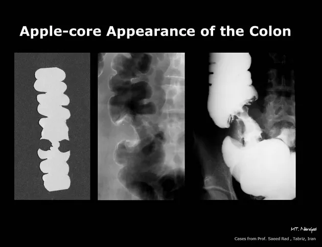 Apple-core lesion on barium enema