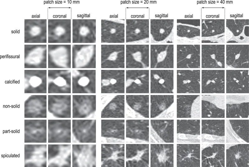 CT: Lung nodule types and sizes