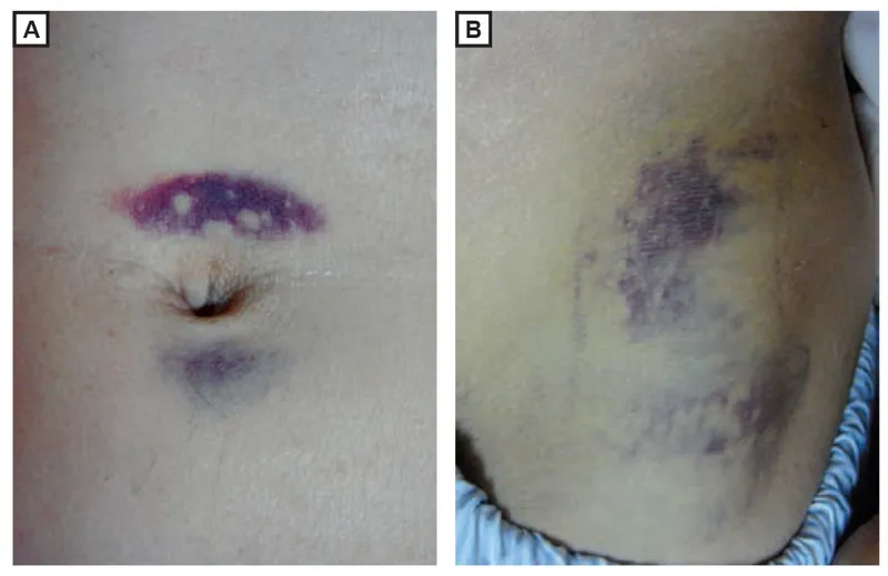 Cullen's and Grey Turner's signs in acute pancreatitis