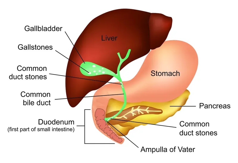 Gallstone Pancreatitis: Anatomy and Stone Location
