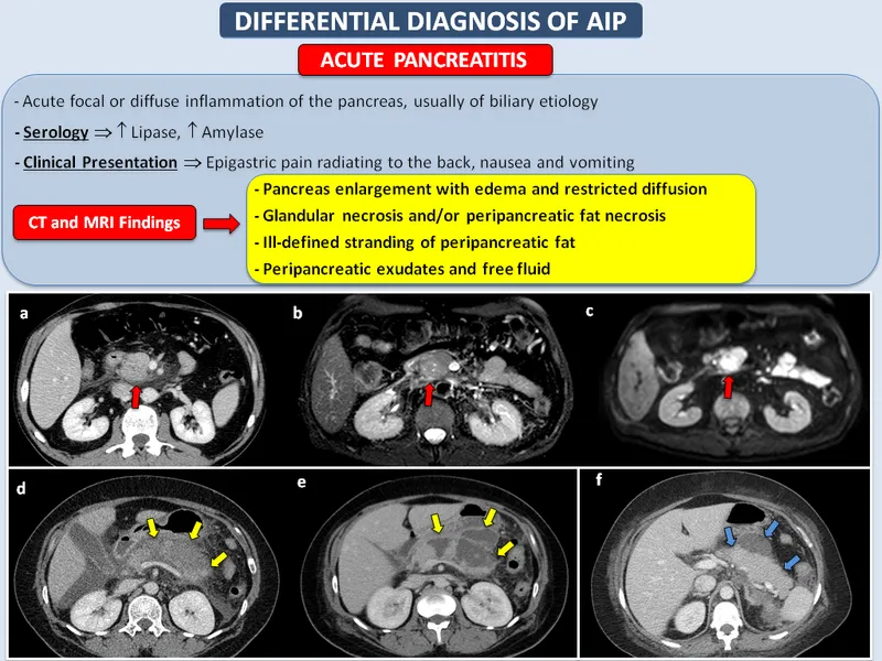 CT/MRI findings in acute pancreatitis