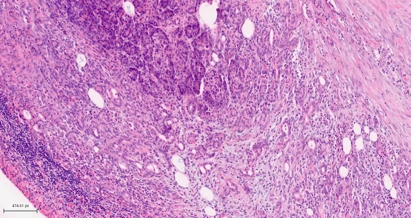Histopathology of Acute Pancreatitis