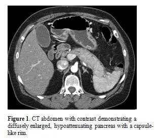 CT: Diffusely enlarged, hypoattenuating pancreas