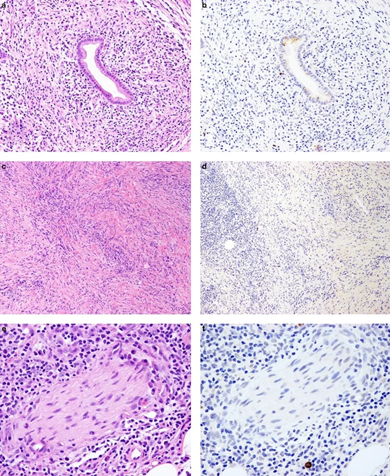 Histology of Autoimmune Pancreatitis