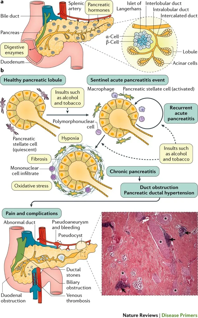 Chronic Pancreatitis Pathophysiology