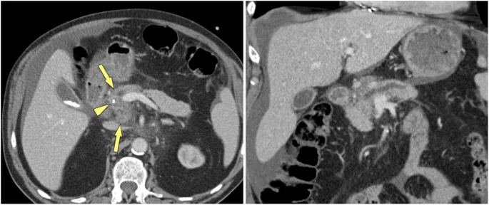 CT: Pancreatic Calcifications & Ductal Dilation