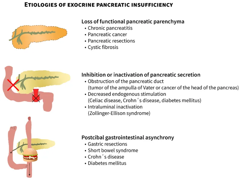 Etiologies of Exocrine Pancreatic Insufficiency