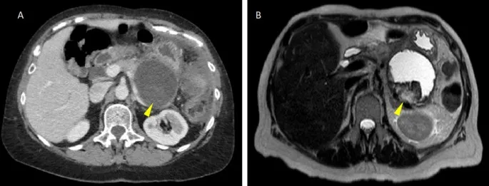 Walled-off necrosis on CT and MRI