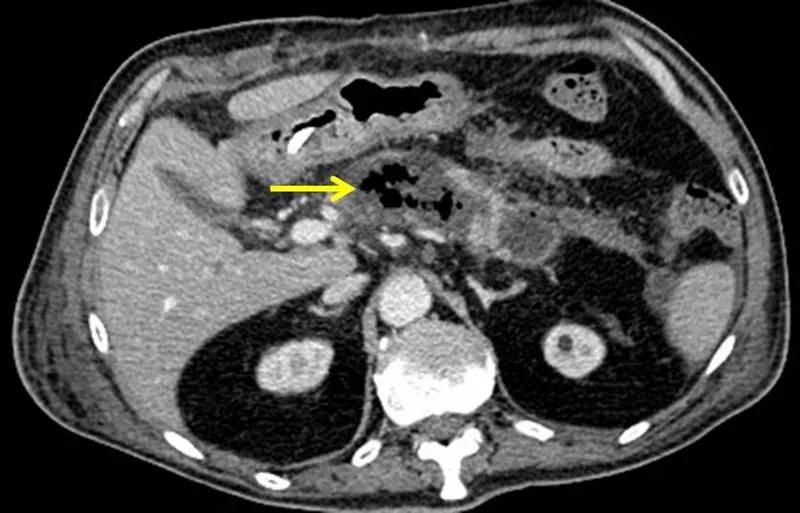 CT scan: Infected pancreatic necrosis with gas bubbles