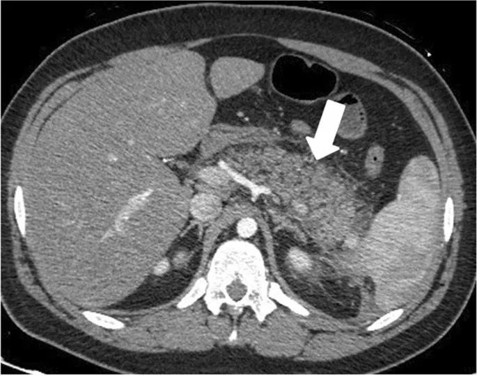 CT: Pancreatic necrosis in acute pancreatitis