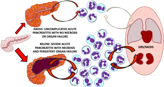 SIRS/MODS in Acute Pancreatitis: Uncomplicated vs. Severe