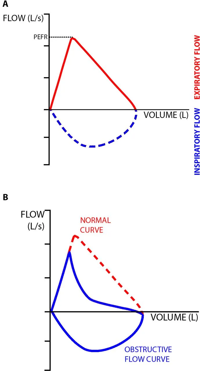 Spirometry flow-volume loops: normal vs. obstructive pattern