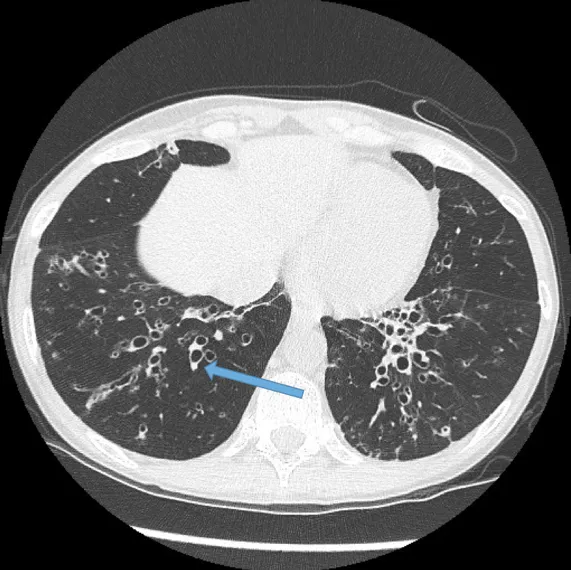 CT Chest: Bronchiectasis with signet ring sign