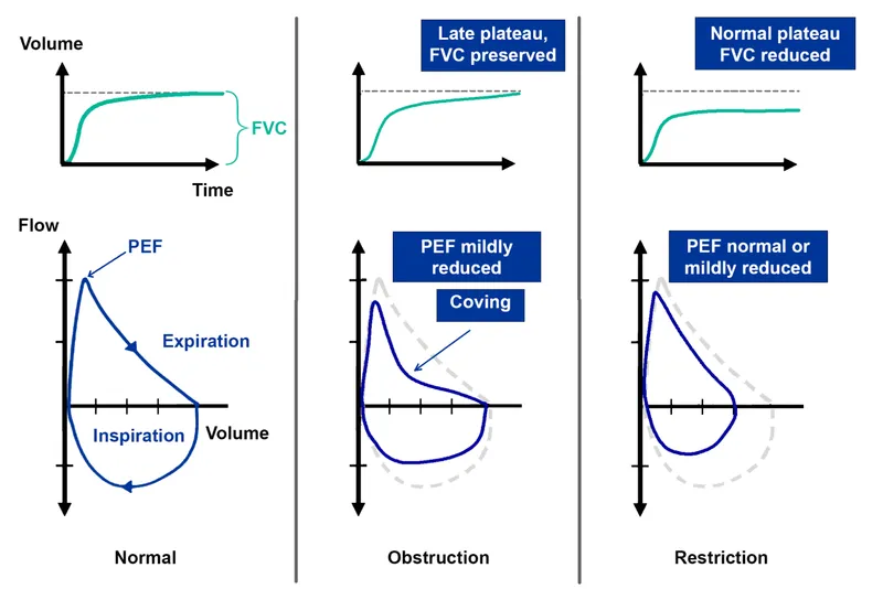 Spirometry: Normal, Obstructive, and Restrictive Patterns