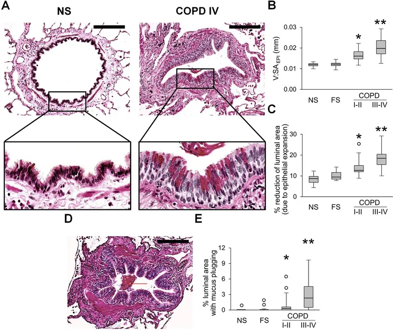 COPD Airway Histology: Normal vs. COPD with Mucus