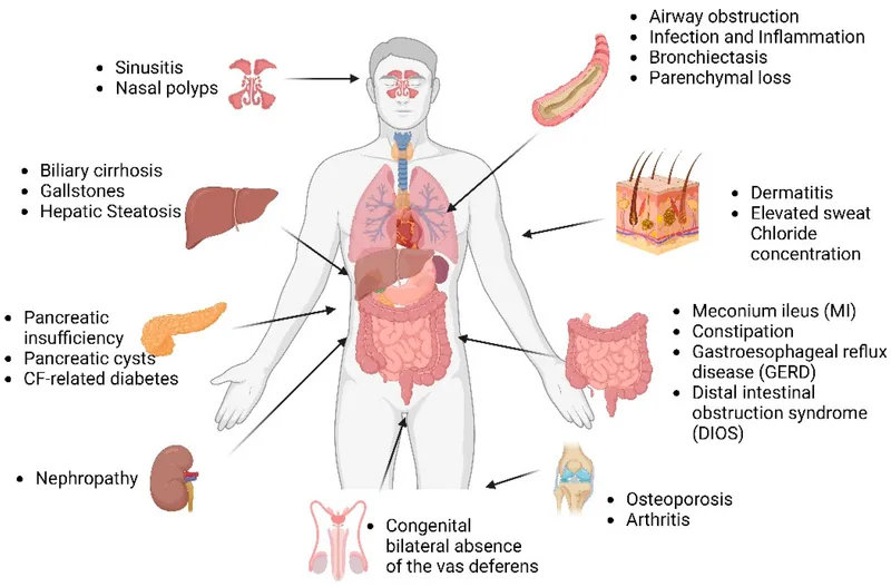 Cystic Fibrosis: Multi-organ Manifestations