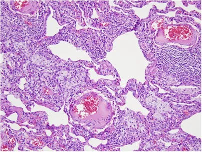 Histopathology of Hypersensitivity Pneumonitis