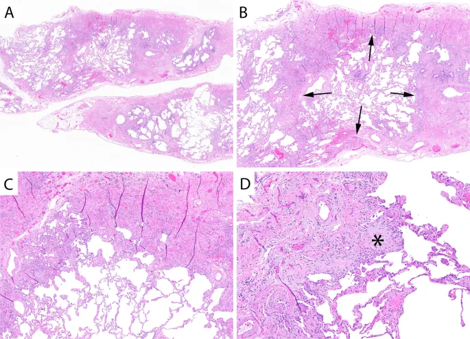 UIP Histology: Fibroblastic Foci & Honeycomb Change