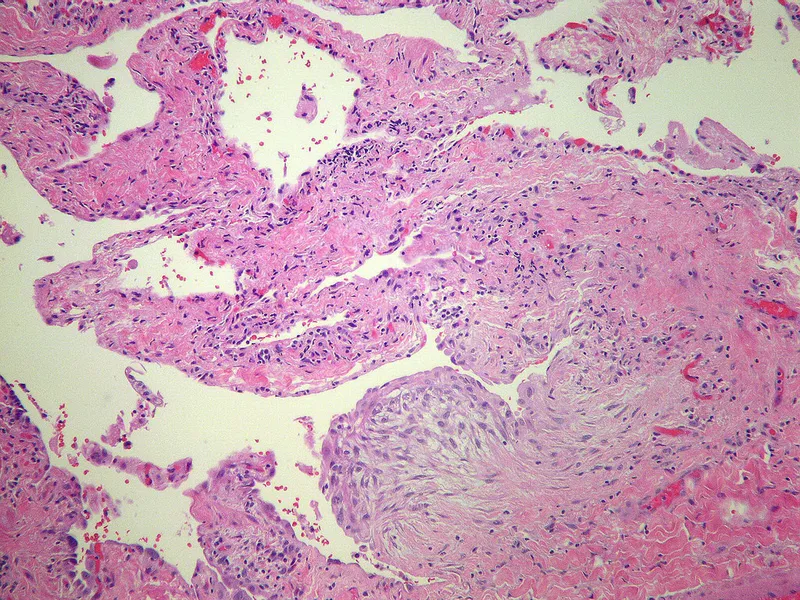 UIP Histopathology with Fibroblastic Foci
