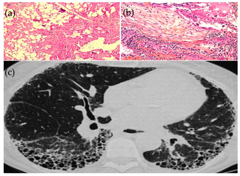 HRCT of IPF with honeycomb lung and histology