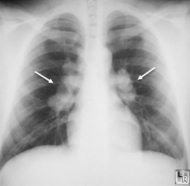 Chest X-ray: Bilateral hilar lymphadenopathy in sarcoidosis