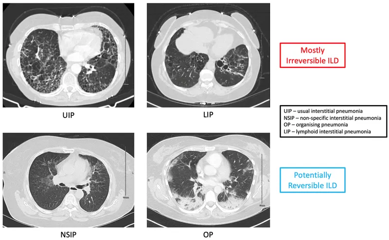 CT scans of ILD patterns: UIP, LIP, NSIP, OP