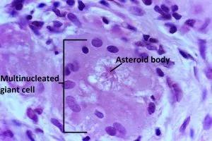 Asteroid body in multinucleated giant cell in sarcoidosis