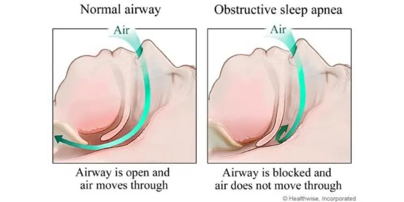 Normal vs. Obstructed Airway in Sleep Apnea