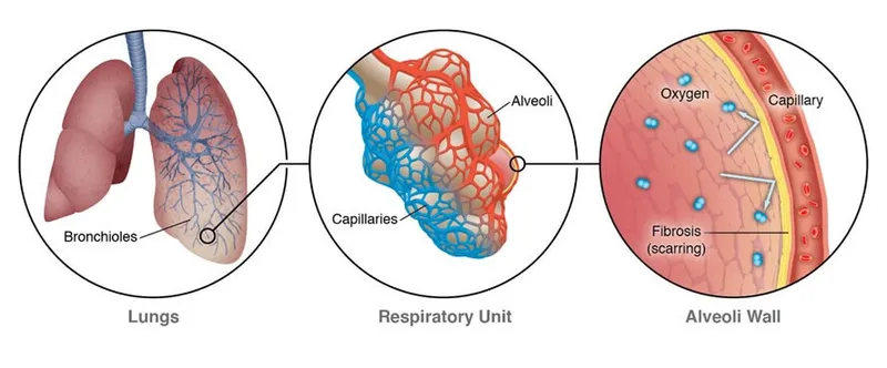 Alveolar-capillary unit and fibrosis in ILD
