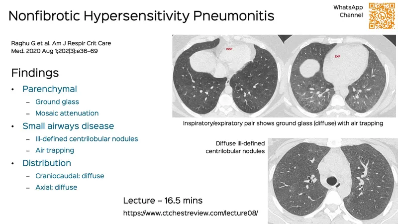 HRCT Nonfibrotic Hypersensitivity Pneumonitis Findings