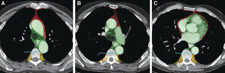 CT scan showing mediastinal compartments