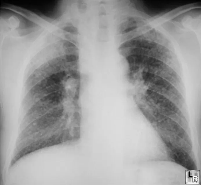 Silicosis Chest X-ray with egg-shell calcification