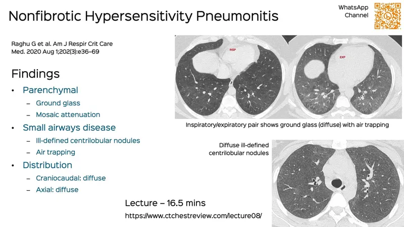 HRCT: Nonfibrotic Hypersensitivity Pneumonitis Findings