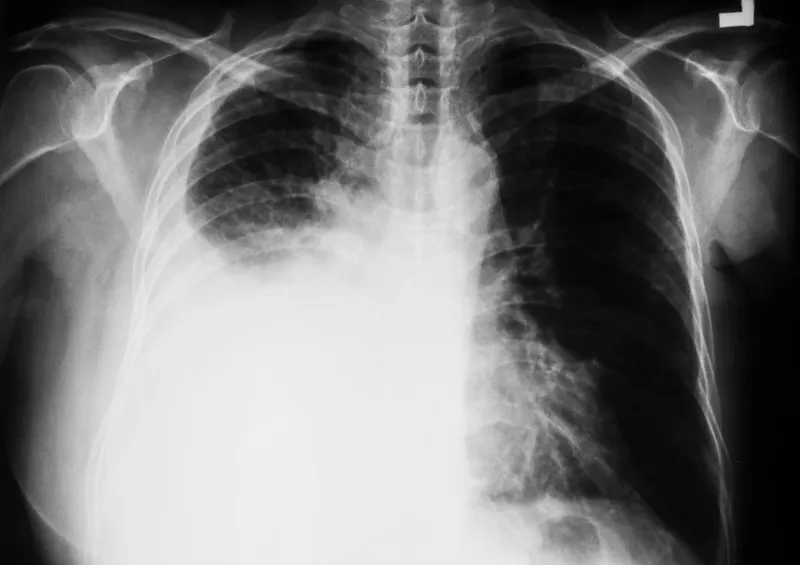 CXR PA view showing right sided pleural effusion