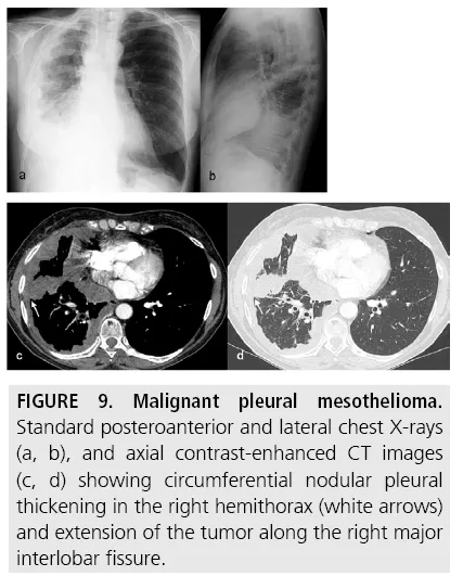 Malignant pleural mesothelioma CXR and CT
