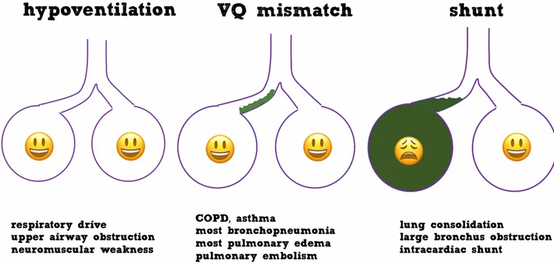 Mechanisms of Respiratory Failure
