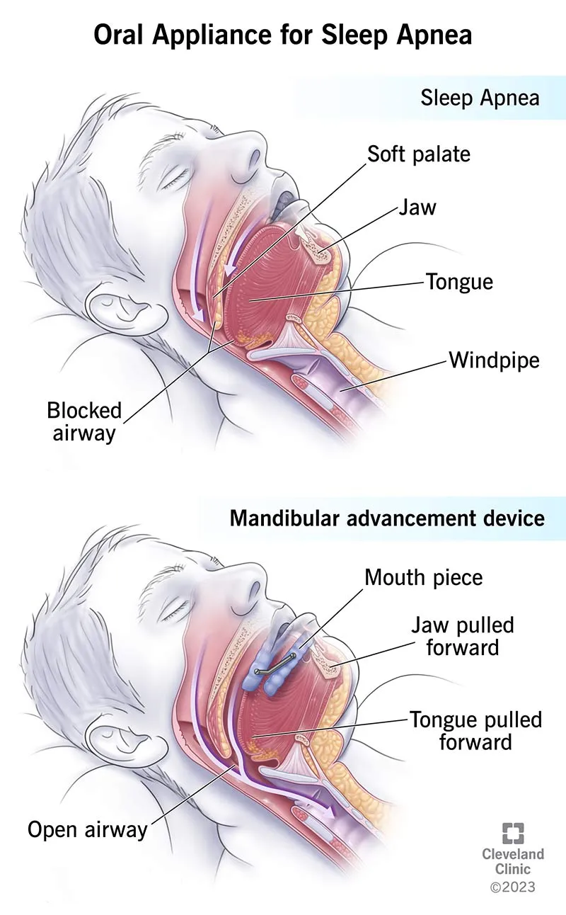 Oral appliance for sleep apnea