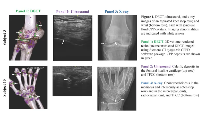 Chondrocalcinosis in knee and wrist X-ray