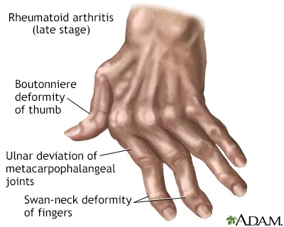 Late stage RA hand deformities
