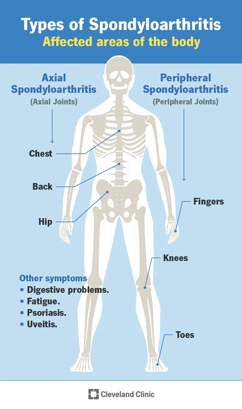 Spondyloarthritis: Affected Body Areas and Other Symptoms