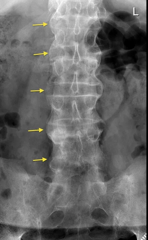 Ankylosing Spondylitis: Bamboo Spine X-ray
