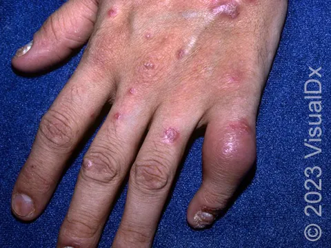 Psoriatic arthritis: dactylitis and nail changes