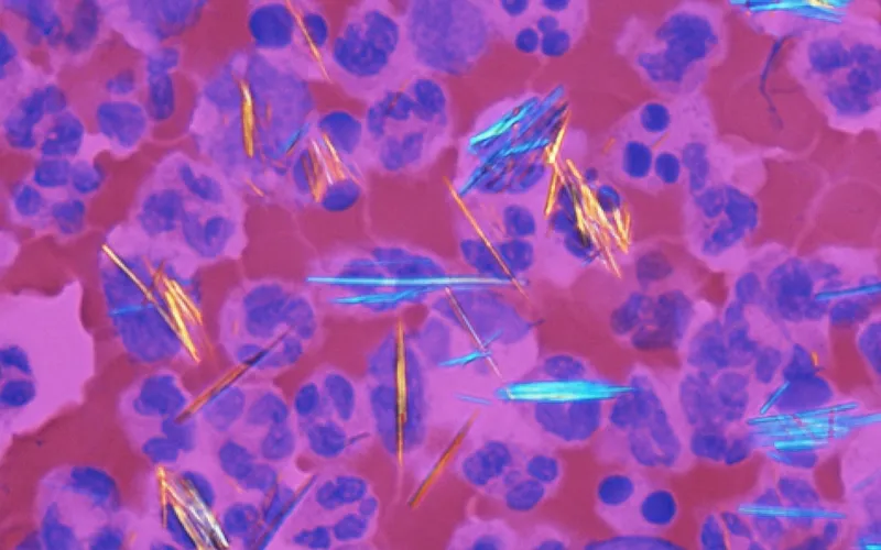 Gout and pseudogout crystals in synovial fluid aspirate