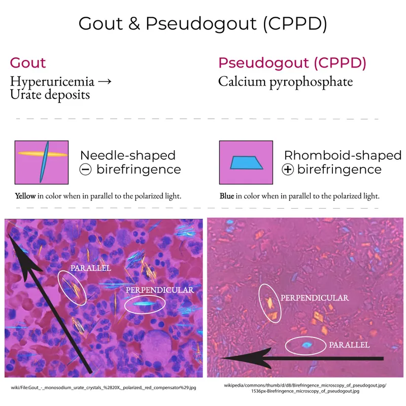 Gout vs. Pseudogout: Crystal Microscopy & Birefringence