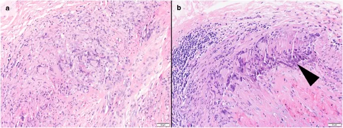 Giant Cell Arteritis Histopathology with Giant Cells