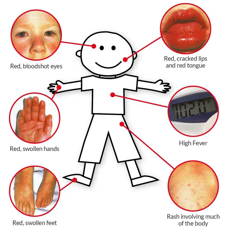 Kawasaki Disease Symptoms